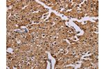 The image on the left is immunohistochemistry of paraffin-embedded Human prostate cancer tissue using CSB-PA276669(CSNK1A1 Antibody) at dilution 1/20, on the right is treated with synthetic peptide. (Original magnification: 