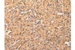 The image on the left is immunohistochemistry of paraffin-embedded Human liver cancer tissue using CSB-PA276755(AQP7 Antibody) at dilution 1/40, on the right is treated with synthetic peptide. (Original magnification: 