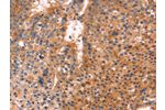 The image on the left is immunohistochemistry of paraffin-embedded Human liver cancer tissue using CSB-PA276953(ANTXR1 Antibody) at dilution 1/25, on the right is treated with fusion protein. (Original magnification: 
