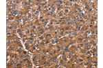 The image on the left is immunohistochemistry of paraffin-embedded Human liver cancer tissue using CSB-PA276963(ELP2 Antibody) at dilution 1/40, on the right is treated with fusion protein. (Original magnification: 