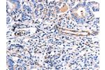 The image on the left is immunohistochemistry of paraffin-embedded Human stomach cancer tissue using CSB-PA277061(COX11 Antibody) at dilution 1/30, on the right is treated with fusion protein. (Original magnification: 