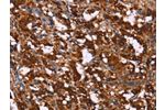 The image on the left is immunohistochemistry of paraffin-embedded Human thyroid cancer tissue using CSB-PA277276(GAGE12I Antibody) at dilution 1/20, on the right is treated with synthetic peptide. (Original magnification: 