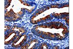 The image on the left is immunohistochemistry of paraffin-embedded Human cervical cancer tissue using CSB-PA277440(EPHX1 Antibody) at dilution 1/20, on the right is treated with fusion protein. (Original magnification: 