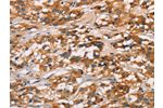 The image on the left is immunohistochemistry of paraffin-embedded Human thyroid cancer tissue using CSB-PA277650(CD80 Antibody) at dilution 1/50, on the right is treated with synthetic peptide. (Original magnification: 