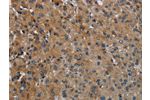 The image on the left is immunohistochemistry of paraffin-embedded Human liver cancer tissue using CSB-PA277783(FAAH Antibody) at dilution 1/50, on the right is treated with fusion protein. (Original magnification: 