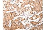 The image on the left is immunohistochemistry of paraffin-embedded Human ovarian cancer tissue using CSB-PA277795(BGLAP Antibody) at dilution 1/60, on the right is treated with synthetic peptide. (Original magnification: 