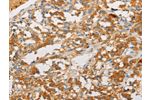 The image on the left is immunohistochemistry of paraffin-embedded Human thyroid cancer tissue using CSB-PA278026(ART3 Antibody) at dilution 1/40, on the right is treated with fusion protein. (Original magnification: 