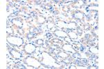 The image on the left is immunohistochemistry of paraffin-embedded Human thyroid cancer tissue using CSB-PA279017(ACSM5 Antibody) at dilution 1/35, on the right is treated with fusion protein. (Original magnification: 
