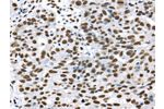 The image on the left is immunohistochemistry of paraffin-embedded Human breast cancer tissue using CSB-PA279529(DDX39B Antibody) at dilution 1/35, on the right is treated with synthetic peptide. (Original magnification: 