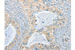 The image on the left is immunohistochemistry of paraffin-embedded Human cervical cancer tissue using CSB-PA279534(CHRNA2 Antibody) at dilution 1/40, on the right is treated with synthetic peptide. (Original magnification: 