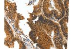 The image on the left is immunohistochemistry of paraffin-embedded Human colon cancer tissue using CSB-PA279642(BIRC6 Antibody) at dilution 1/30, on the right is treated with synthetic peptide. (Original magnification: 