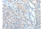 The image on the left is immunohistochemistry of paraffin-embedded Human lung cancer tissue using CSB-PA280169(AKAP9 Antibody) at dilution 1/10, on the right is treated with fusion protein. (Original magnification: 