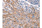 The image on the left is immunohistochemistry of paraffin-embedded Human liver cancer tissue using CSB-PA280305(CDK5 Antibody) at dilution 1/10, on the right is treated with fusion protein. (Original magnification: 