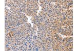The image on the left is immunohistochemistry of paraffin-embedded Human liver cancer tissue using CSB-PA280651(B3GAT1 Antibody) at dilution 1/50, on the right is treated with synthetic peptide. (Original magnification: 