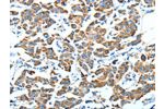 The image on the left is immunohistochemistry of paraffin-embedded Human breast cancer tissue using CSB-PA280938(ALDH6A1 Antibody) at dilution 1/45, on the right is treated with fusion protein. (Original magnification: 