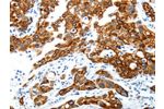 The image on the left is immunohistochemistry of paraffin-embedded Human lung cancer tissue using CSB-PA281021(ABI3BP Antibody) at dilution 1/25, on the right is treated with synthetic peptide. (Original magnification: 