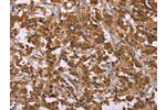 The image on the left is immunohistochemistry of paraffin-embedded Human thyroid cancer tissue using CSB-PA281322(CMTM6 Antibody) at dilution 1/30, on the right is treated with synthetic peptide. (Original magnification: 