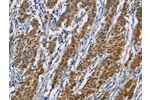 The image on the left is immunohistochemistry of paraffin-embedded Human gastic cancer tissue using CSB-PA281732(ACVR1 Antibody) at dilution 1/60, on the right is treated with fusion protein. (Original magnification: 