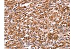 The image on the left is immunohistochemistry of paraffin-embedded Human thyroid cancer tissue using CSB-PA281738(AMER1 Antibody) at dilution 1/40, on the right is treated with synthetic peptide. (Original magnification: 