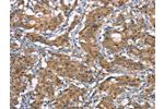 The image on the left is immunohistochemistry of paraffin-embedded Human gastic cancer tissue using CSB-PA281759(CDC25A Antibody) at dilution 1/50, on the right is treated with synthetic peptide. (Original magnification: 