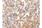 The image on the left is immunohistochemistry of paraffin-embedded Human thyroid cancer tissue using CSB-PA282084(CPSF4 Antibody) at dilution 1/30, on the right is treated with fusion protein. (Original magnification: 