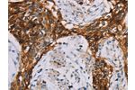 The image on the left is immunohistochemistry of paraffin-embedded Human esophagus cancer tissue using CSB-PA282285(CD44 Antibody) at dilution 1/35, on the right is treated with fusion protein. (Original magnification: 