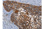 The image on the left is immunohistochemistry of paraffin-embedded Human cervical cancer tissue using CSB-PA282654(CD68 Antibody) at dilution 1/30, on the right is treated with synthetic peptide. (Original magnification: 