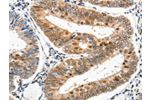 The image on the left is immunohistochemistry of paraffin-embedded Human cervical cancer tissue using CSB-PA282824(DDB1 Antibody) at dilution 1/25, on the right is treated with synthetic peptide. (Original magnification: 