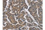 The image on the left is immunohistochemistry of paraffin-embedded Human breast cancer tissue using CSB-PA283024(DHRS3 Antibody) at dilution 1/30, on the right is treated with fusion protein. (Original magnification: 