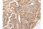 The image on the left is immunohistochemistry of paraffin-embedded Human breast cancer tissue using CSB-PA283108(CLDND2 Antibody) at dilution 1/45, on the right is treated with synthetic peptide. (Original magnification: 