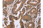 The image on the left is immunohistochemistry of paraffin-embedded Human colon cancer tissue using CSB-PA283664(EPDR1 Antibody) at dilution 1/20, on the right is treated with fusion protein. (Original magnification: 