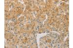 The image on the left is immunohistochemistry of paraffin-embedded Human liver cancer tissue using CSB-PA283716(ACSL4 Antibody) at dilution 1/60, on the right is treated with fusion protein. (Original magnification: 