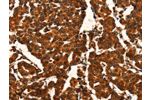 The image on the left is immunohistochemistry of paraffin-embedded Human breast cancer tissue using CSB-PA283839(CUEDC2 Antibody) at dilution 1/50, on the right is treated with fusion protein. (Original magnification: 