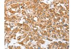 The image on the left is immunohistochemistry of paraffin-embedded Human thyroid cancer tissue using CSB-PA283856(CDR2 Antibody) at dilution 1/30, on the right is treated with fusion protein. (Original magnification: 