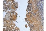 The image on the left is immunohistochemistry of paraffin-embedded Human tonsil tissue using CSB-PA284504(DLG4 Antibody) at dilution 1/30, on the right is treated with synthetic peptide. (Original magnification: 