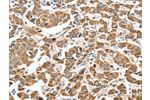 The image on the left is immunohistochemistry of paraffin-embedded Human breast cancer tissue using CSB-PA284873(ALDH9A1 Antibody) at dilution 1/50, on the right is treated with synthetic peptide. (Original magnification: 