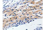 The image on the left is immunohistochemistry of paraffin-embedded Human liver cancer tissue using CSB-PA285560(CLDN5 Antibody) at dilution 1/5, on the right is treated with synthetic peptide. (Original magnification: 