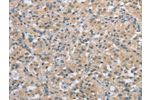 The image on the left is immunohistochemistry of paraffin-embedded Human thyroid cancer tissue using CSB-PA285697(C2orf40 Antibody) at dilution 1/20, on the right is treated with synthetic peptide. (Original magnification: 