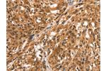 The image on the left is immunohistochemistry of paraffin-embedded Human esophagus cancer tissue using CSB-PA285746(CCNE2 Antibody) at dilution 1/25, on the right is treated with synthetic peptide. (Original magnification: 