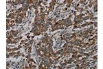 The image on the left is immunohistochemistry of paraffin-embedded Human liver cancer tissue using CSB-PA285771(CFLAR Antibody) at dilution 1/20, on the right is treated with synthetic peptide. (Original magnification: 