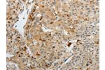 The image on the left is immunohistochemistry of paraffin-embedded Human cervical cancer tissue using CSB-PA285910(F13A1 Antibody) at dilution 1/15, on the right is treated with fusion protein. (Original magnification: 