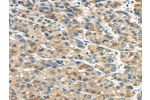 The image on the left is immunohistochemistry of paraffin-embedded Human liver cancer tissue using CSB-PA286159(GLP2R Antibody) at dilution 1/30, on the right is treated with fusion protein. (Original magnification: 