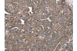 The image on the left is immunohistochemistry of paraffin-embedded Human cervical cancer tissue using CSB-PA286186(FAIM2 Antibody) at dilution 1/40, on the right is treated with fusion protein. (Original magnification: 