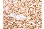 The image on the left is immunohistochemistry of paraffin-embedded Human esophagus cancer tissue using CSB-PA286404(AMD1 Antibody) at dilution 1/25, on the right is treated with synthetic peptide. (Original magnification: 