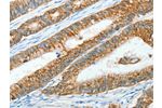 The image on the left is immunohistochemistry of paraffin-embedded Human colon cancer tissue using CSB-PA286707(AGR3 Antibody) at dilution 1/15, on the right is treated with fusion protein. (Original magnification: 
