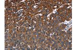 The image on the left is immunohistochemistry of paraffin-embedded Human lung cancer tissue using CSB-PA287660(FCGR3A Antibody) at dilution 1/40, on the right is treated with fusion protein. (Original magnification: 