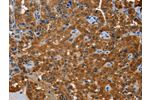 The image on the left is immunohistochemistry of paraffin-embedded Human thyroid cancer tissue using CSB-PA287728(ACY1 Antibody) at dilution 1/20, on the right is treated with fusion protein. (Original magnification: 