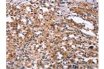 The image on the left is immunohistochemistry of paraffin-embedded Human thyroid cancer tissue using CSB-PA287752(GCKR Antibody) at dilution 1/15, on the right is treated with synthetic peptide. (Original magnification: 