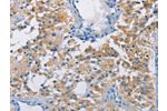 The image on the left is immunohistochemistry of paraffin-embedded Human thyroid cancer tissue using CSB-PA288252(ATP6AP2 Antibody) at dilution 1/40, on the right is treated with fusion protein. (Original magnification: 