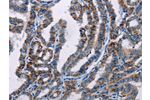 The image on the left is immunohistochemistry of paraffin-embedded Human thyroid cancer tissue using CSB-PA288314(FHIT Antibody) at dilution 1/25, on the right is treated with fusion protein. (Original magnification: 